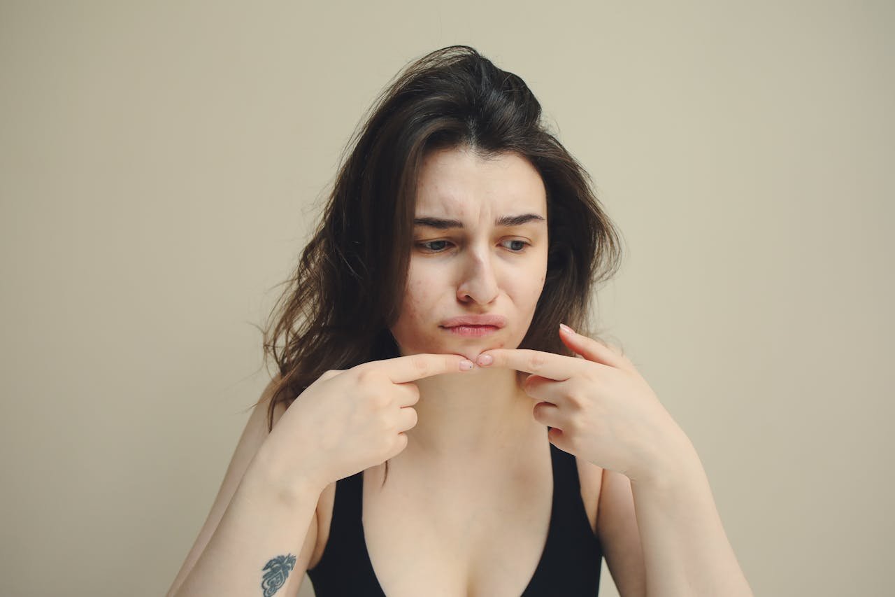 Read more about the article Hormonal Acne Healing Through the Stress-Skin Connection: A Gentle, Practical Path to Understanding Your Acne