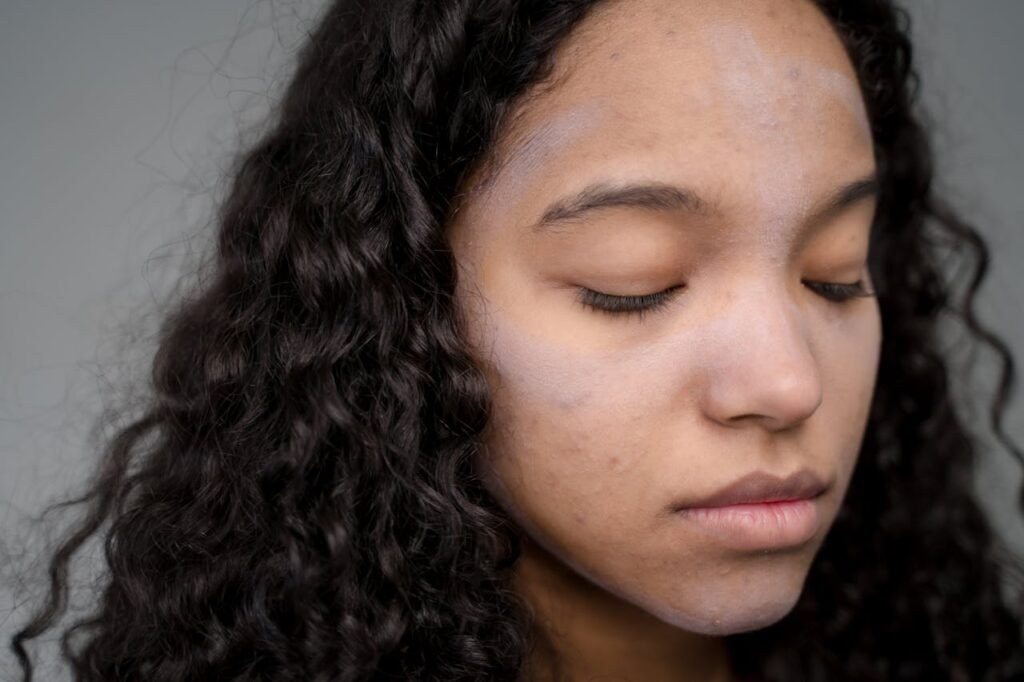 A girl with acne skin